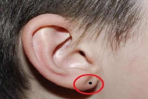 Nốt ruồi ở dái tai nói gì về tương lai của bạn? Vượng tài lộc hay nghèo mạt kiếp?