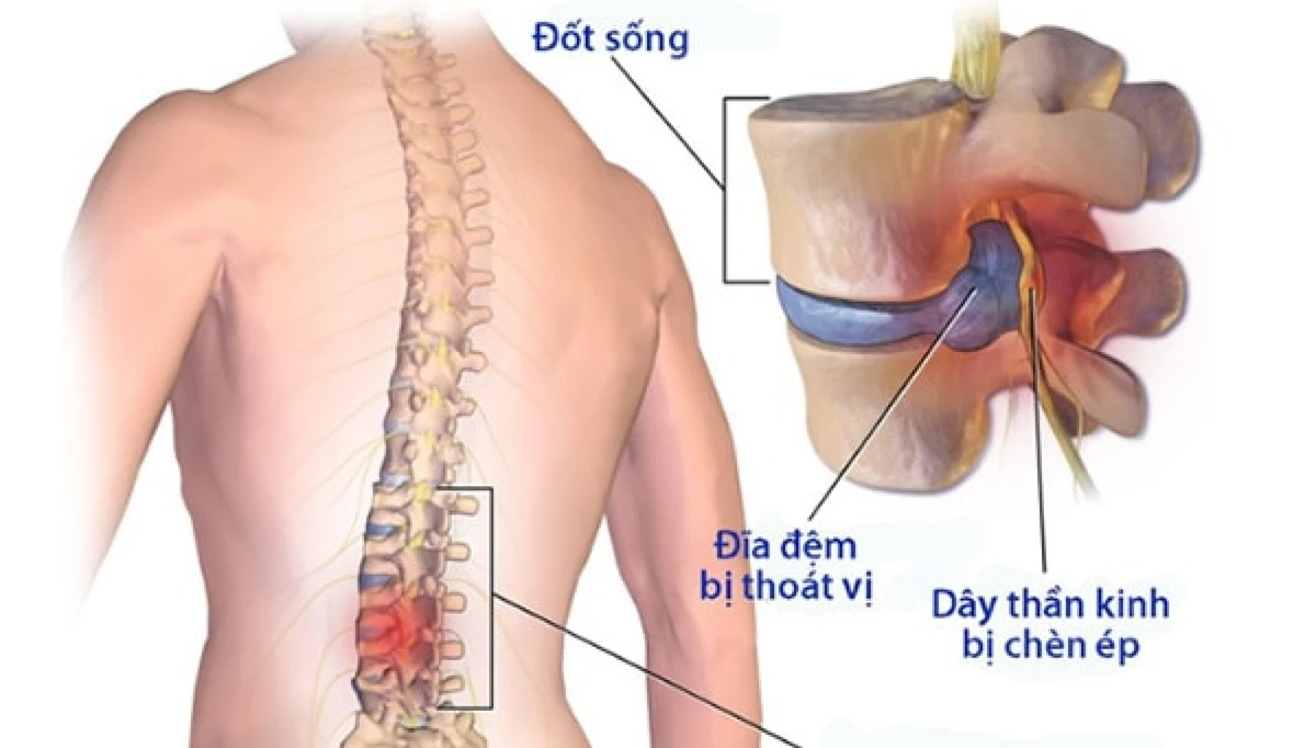 lam the nao de giam nguy co bi benh dau that lung hinh anh 1