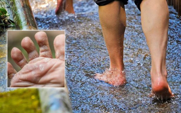 Nước ăn chân mùa mưa và cách xử lý tại nhà hiệu quả nhất