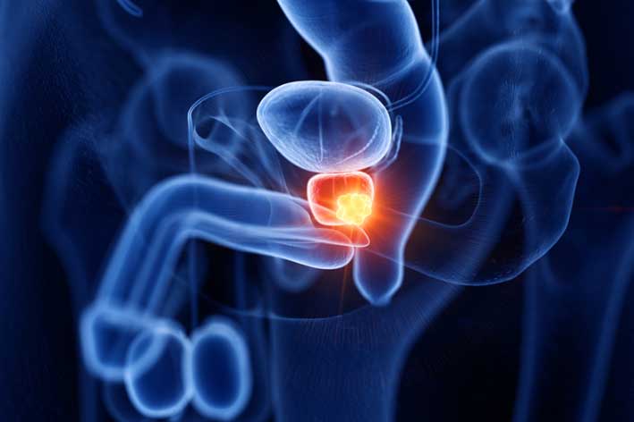 3 căn bệnh ung thư không có triệu chứng sớm