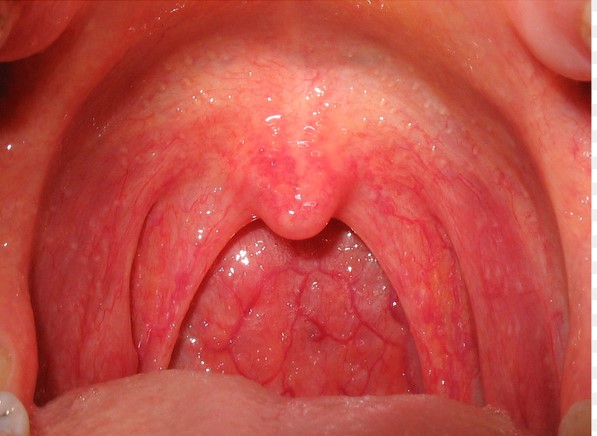 Hỗ trợ điều trị viêm họng từ những thảo dược tự nhiên ngay tại nhà