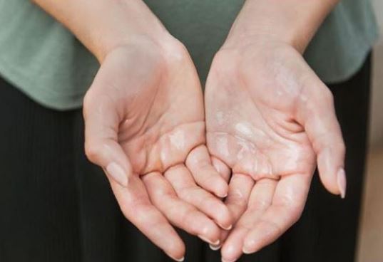 Những cách khắc phục chứng ra mồ hôi tay, mồ hôi chân hiệu quả