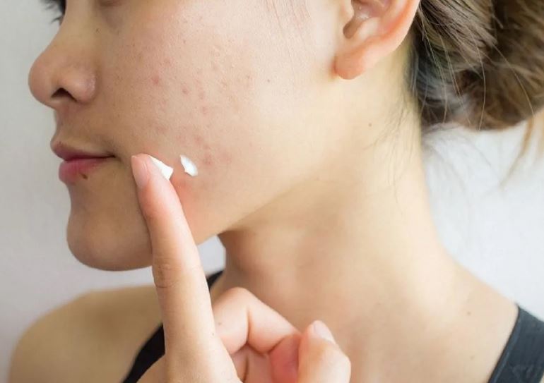 Những việc nên làm khi làn da của bạn bị mụn trứng cá hoành hành