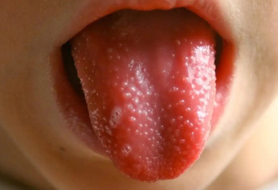 Lưỡi bạn có những dấu hiệu này, coi chừng bạn đang mắc vấn đề nghiêm trọng về sức khỏe