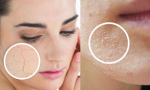 Bí quyết khắc phục tình trạng da khô ráp