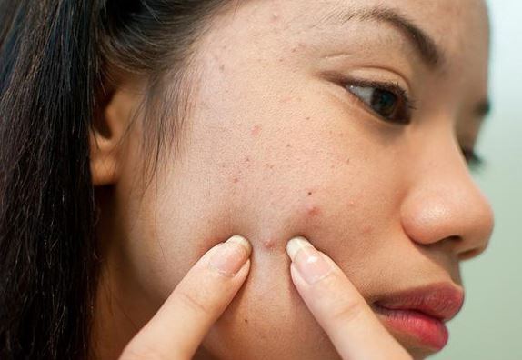 Nặn mụn sai cách có thể khiến bạn phải trả giá đắt