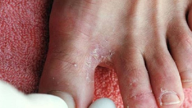 M&#x1EB9;o tr&#x1ECB; n&#x1B0;&#x1EDB;c &#x103;n ch&#xE2;n c&#x1EF1;c &#x111;&#x1A1;n gi&#x1EA3;n v&#xE0; hi&#x1EC7;u qu&#x1EA3; ngay t&#x1EA1;i nh&#xE0;