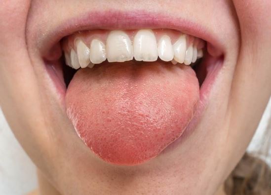 Dấu hiệu trong miệng nhận biết sự thiếu hụt vitamin B12