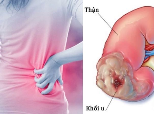 5 dấu hiệu cảnh báo ung thư thận không nên bỏ qua