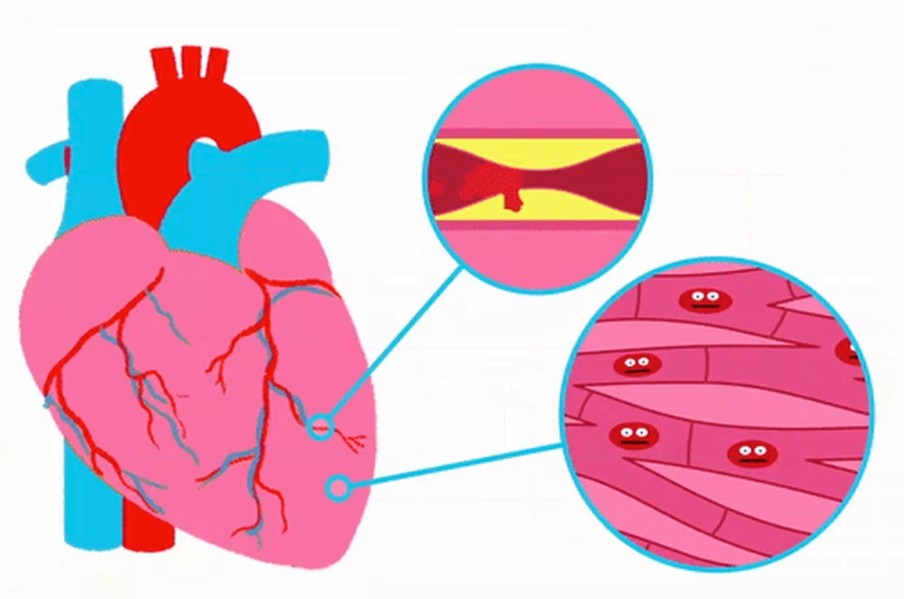 Clip: Khối mỡ nhỏ trong mạch máu có thể dẫn đến cái chết chớp nhoáng như thế nào?