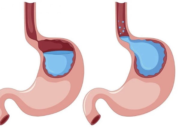 Lạm dụng thuốc trị trào ngược axit tăng nguy cơ mất trí nhớ