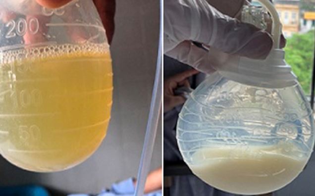 Nước tiểu màu trắng đục như sữa báo hiệu bệnh về tiết niệu nguy hiểm