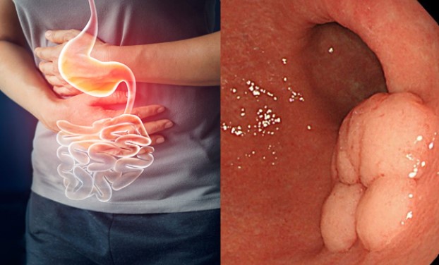 Các triệu chứng liên quan tới ung thư dạ dày, cần đi gặp bác sĩ ngay