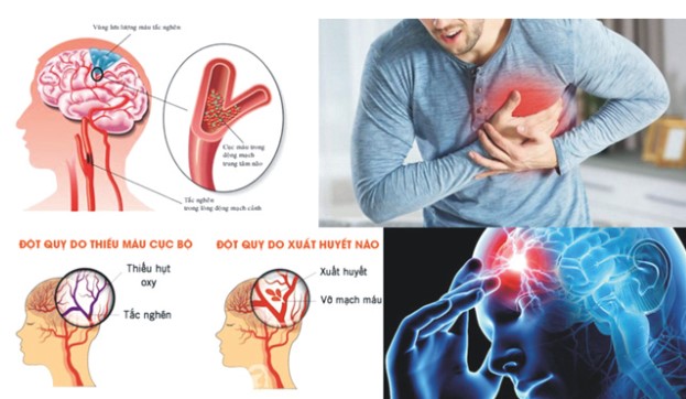 Có biết được dấu hiệu đột quỵ trước 30 ngày, 1 tuần hay 1 ngày không? Và cách sơ cứu khi gặp phải