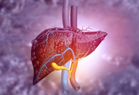 Bác sĩ gan liệt kê 6 dấu hiệu của gan nhiễm mỡ, căn bệnh nguy hiểm thầm lặng
