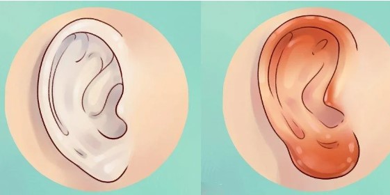Sắc thái của đôi tai 'tố cáo' sức khỏe của bạn như thế nào?