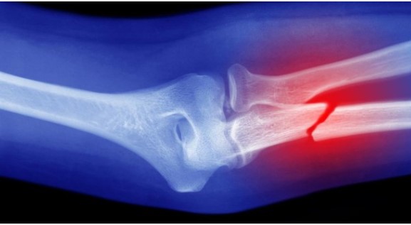 Lý do kỳ lạ và đáng lo ngại khiến xương của chúng ta ngày càng giòn, kể cả ở người trẻ