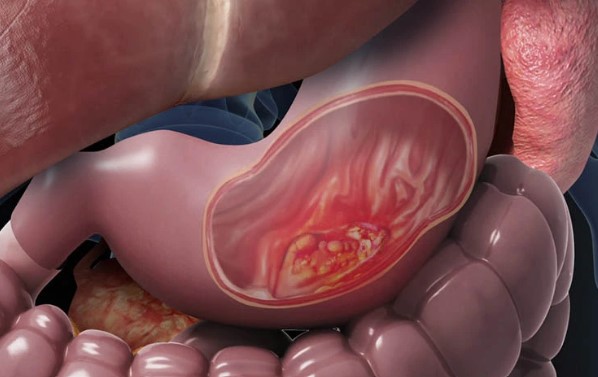 3 kiểu ăn uống 'độc khủng khiếp' mà người trẻ cần bỏ gấp trước khi làm 'mòn bao tử' và rước thêm ung thư vào người