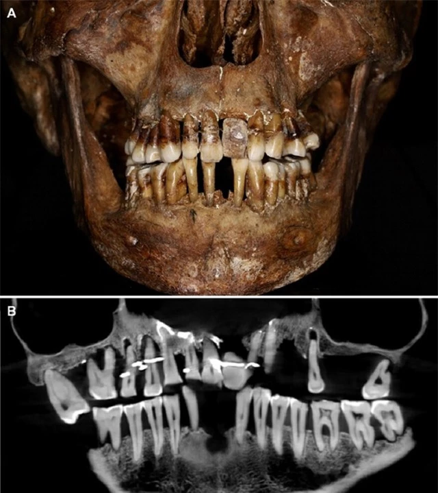 Tiết lộ bí mật hàm răng của xác ướp quý tộc Pháp sau hơn 400 năm - Ảnh 1.