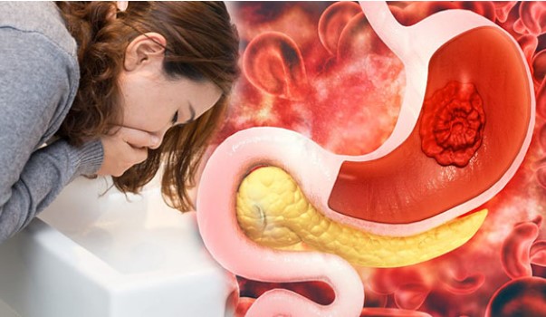 4 dấu hiệu cảnh báo dạ dày của bạn ‘có vấn đề’, nặng hơn là ung thư đang phát triển