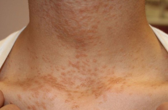 4 dấu hiệu ở cổ cho thấy tế bào ung thư đã xuất hiện trong cơ thể, đi khám ngay kẻo muộn