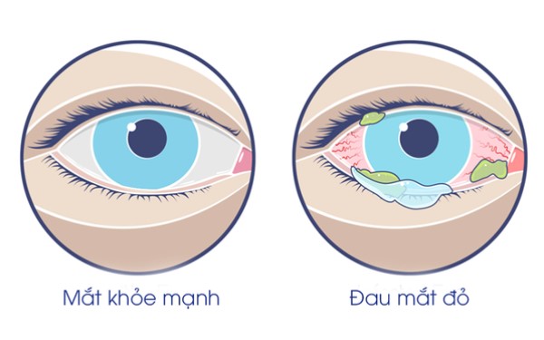 8 thực phẩm nên ăn khi bị đau mắt đỏ để chóng hồi phục