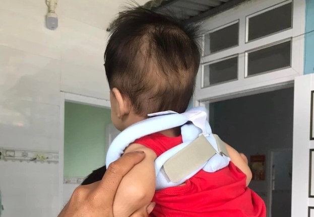 Bé trai 8 tháng ngã từ giường cao 60cm xuống đất, mẹ mải xoa đầu nhưng bàng hoàng hay tin một bộ phận khác bị thương nghiêm trọng