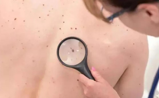 N&#x1ED1;t ru&#x1ED3;i l&#xE0; b&#xEC;nh th&#x1B0;&#x1EDD;ng nh&#x1B0;ng n&#x1EBF;u &quot;m&#x1ECD;c&quot; &#x1EDF; 4 b&#x1ED9; ph&#x1EAD;n n&#xE0;y th&#xEC; c&#x1EA7;n h&#x1EBF;t s&#x1EE9;c ch&#xFA; &#xFD;, c&#xF3; th&#x1EC3; tr&#x1EDF; th&#xE0;nh ung th&#x1B0; b&#x1EA5;t c&#x1EE9; l&#xFA;c n&#xE0;o