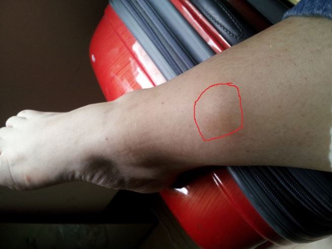 Những dấu hiệu ở chân cho thấy tế bào ung thư bắt đầu "làm loạn", không khám nhanh thì khó cứu vãn