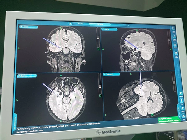 Kết quả chụp MRI chẩn đoán động kinh thái dương trong bên trái của bệnh nhân.