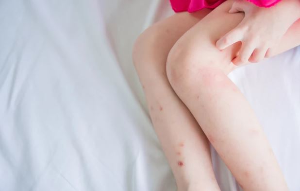 Nên làm gì để loại bỏ các vết thâm do côn trùng cắn