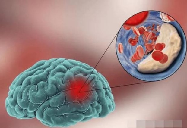 “Chất gia tốc” cho bệnh nhồi máu não không chỉ là muối, bác sĩ nhắc nhở: ba loại gia vị này cho vào nồi càng ít càng tốt