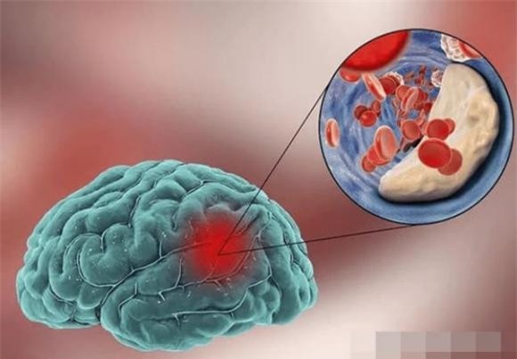 nhoi-mau-nao (1).jpg 0 nhồi máu não, tai biến mạch máu não, sức khỏe, gia vị gây hại