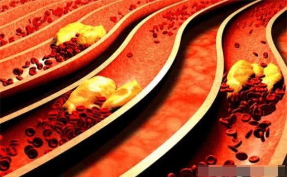 nhoi-mau-nao (1).jpg 3 nhồi máu não, tai biến mạch máu não, sức khỏe, gia vị gây hại