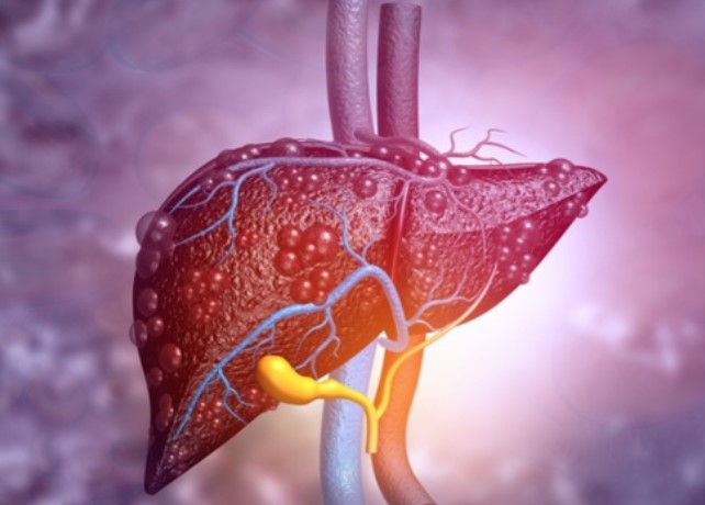 Bác sĩ gan liệt kê 6 dấu hiệu của gan nhiễm mỡ, căn bệnh nguy hiểm thầm lặng