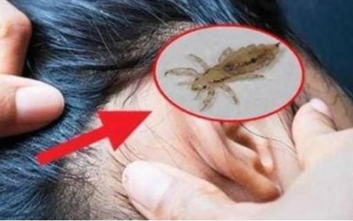 Những sinh vật đã đồng hành cùng con người lâu nhất ở khắp mọi nơi cách đây 30 năm, tại sao bây giờ chúng ta không thấy chấy rận?