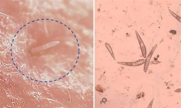 Demodex (1).jpg 2 nang Demodex, ký sinh, phát hiện mới, loài ve Demodex