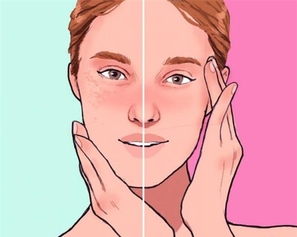 mụn trắng, mụn trắng ở gần mắt, sức khỏe 