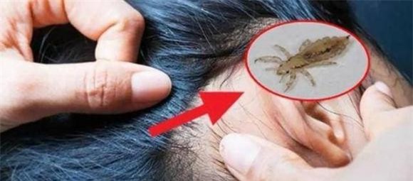 chay (1).jpeg 0 chấy, rận, sinh vật