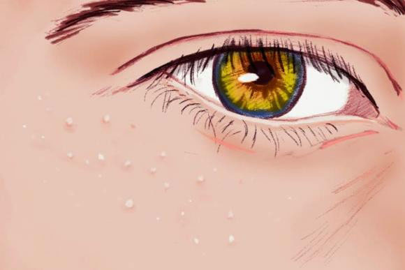 Mụn trắng xuất hiện gần mắt là bệnh gì và tại sao bạn không nên tự mình loại bỏ chúng?