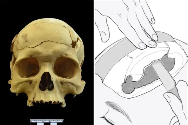 Phát hiện ca phẫu thuật mổ sọ kỳ lạ cách đây 2.700 năm, trước cả thời danh y Hoa Đà - Ảnh 4.