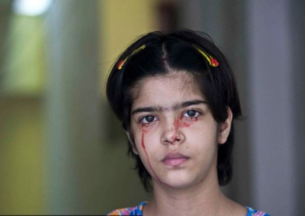 Đi tìm lời giải cho căn bệnh 'khóc ra máu' kỳ quái