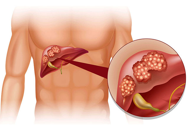 10 dấu hiệu nhận biết sớm bệnh ung thư gan