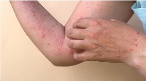 Ca bệnh đậu mùa khỉ đầu tiên tại Cần Thơ đã có dấu hiệu hồi phục 