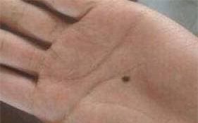 not-ruoi-tren-tay (1).jpeg 0 xem tướng, nốt ruồi, vị trí nốt ruồi, nốt ruồi trên bàn tay