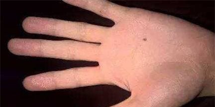 not-ruoi-tren-tay (1).jpeg 3 xem tướng, nốt ruồi, vị trí nốt ruồi, nốt ruồi trên bàn tay