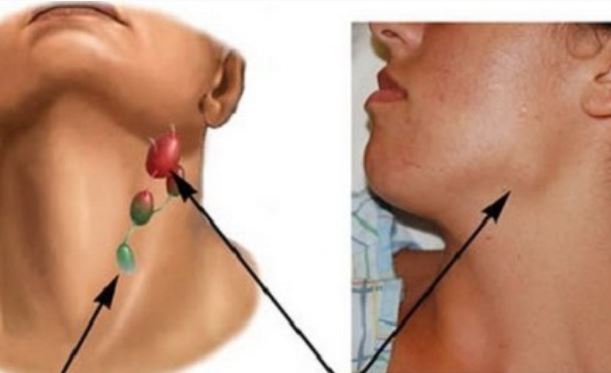 Thấy những biểu hiện này bạn cần đi khám ngay để phát hiện sớm ung thư vòm họng