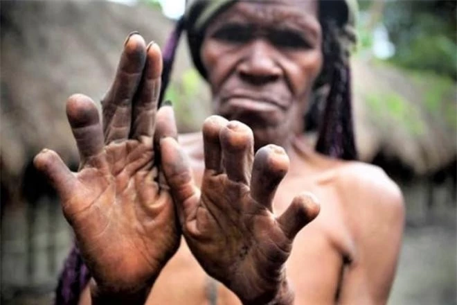 bộ tộc Dani cắt ngón tay khi người thân qua đời 2