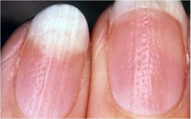 Các đường thẳng đứng và các vết rỗ nhỏ trên móng tay là gì? Có 5 lý do giải thích cho các vết rỗ nhỏ dày đặc