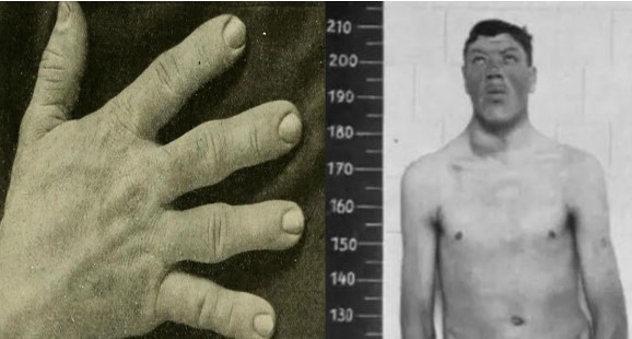 Danh tính người duy nhất trên thế giới hóa từ người lùn thành khổng lồ, có chiều cao 233cm